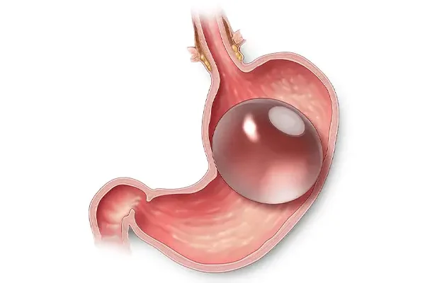 How does Intragastric Balloon work?