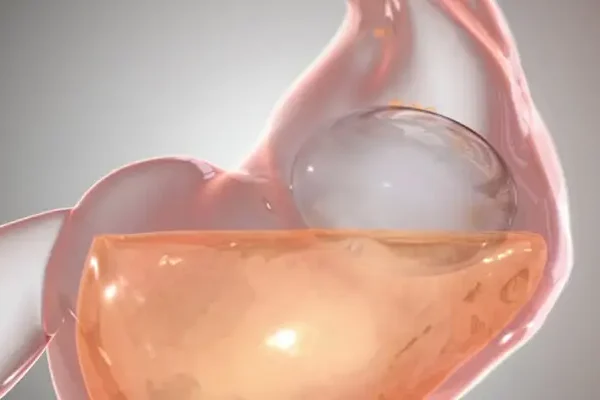 How is the Gastric Balloon inserted?