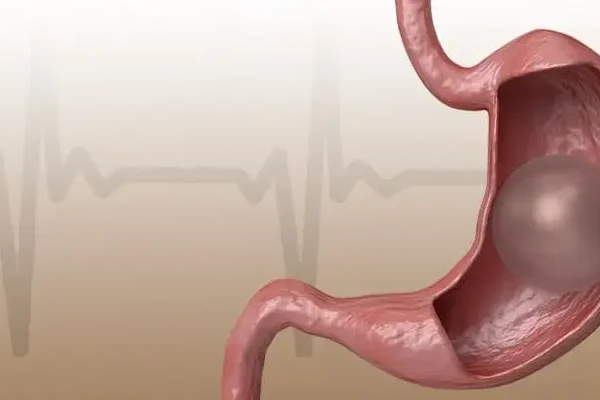 Golden Rules in Gastric Balloon Treatment