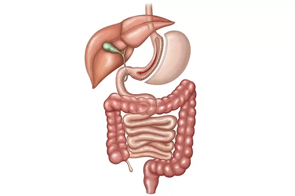 Sleeve Gastrektomi (Tüp Mide)