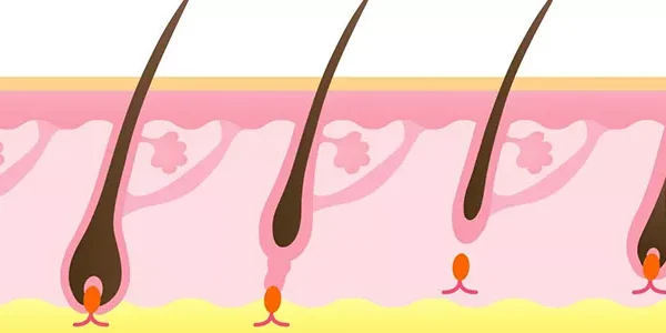 Obezite Cerrahisi Sonrası Saç Dökülmesi