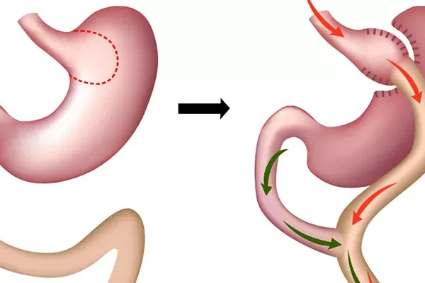 Gastric By-Pass Surgery