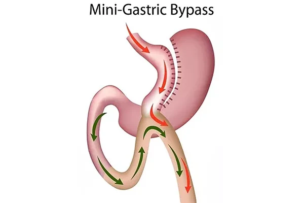 Mini Gastric Bypass