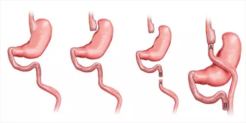 Gastrik Bypass Ameliyatı Sonrası Öneriler ve Bilgiler