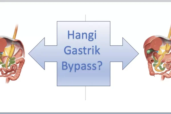 Hangi Gastrik Bypass? Karşılaştırmalı Rehber